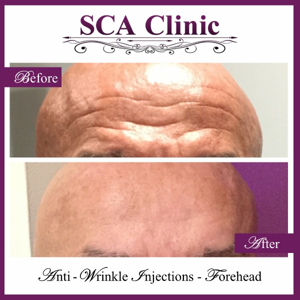 Anti-Wrinkle Injections - Forehead